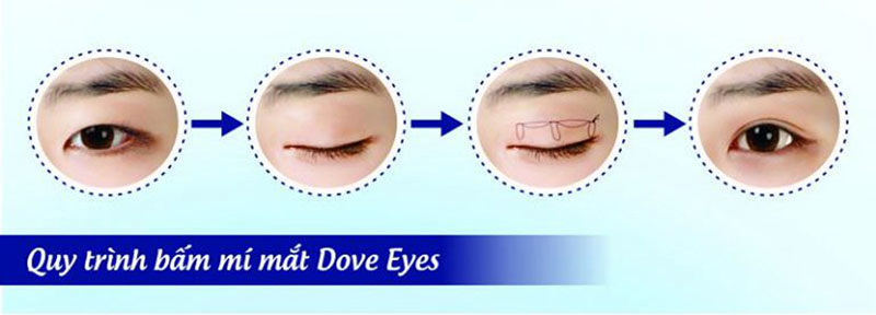 Công nghệ thẩm mỹ Dove Eyes cho bạn đôi mắt đẹp 2