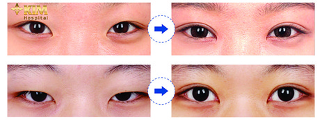 Cách khắc phục mắt xếch trong thời gian ngắn 3